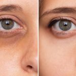 The Latest Trends in Under-Eye Care You Should Know