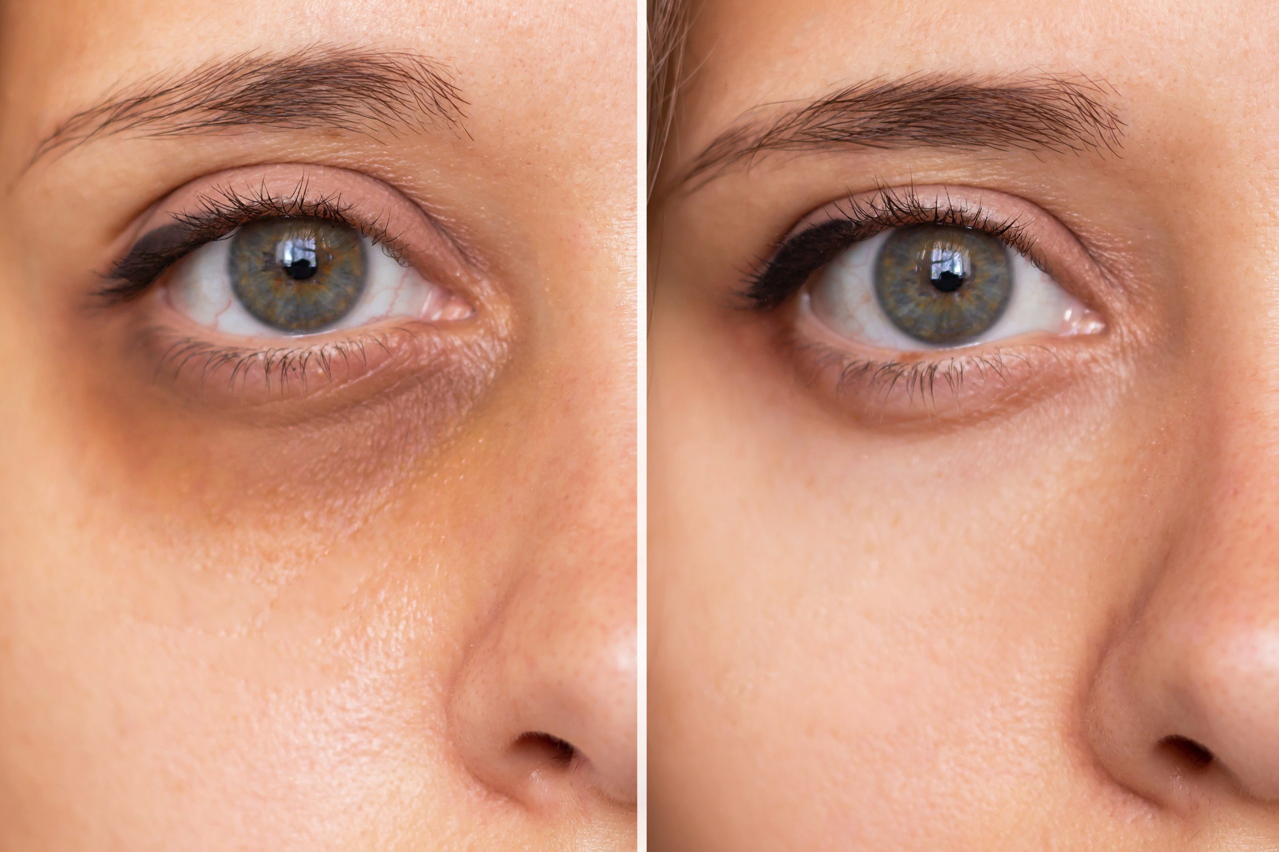 The Latest Trends in Under-Eye Care You Should Know