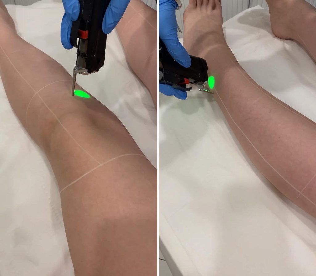 Your Guide to Choosing the Right Laser Hair Removal Machine for Silky Skin